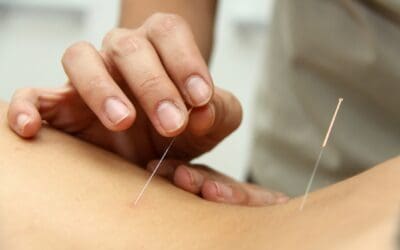 Treating PCOS with Acupuncture & Traditional Chinese Medicine