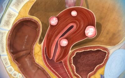 Uterine Fibroids (Myomas Or Leiomyomas)